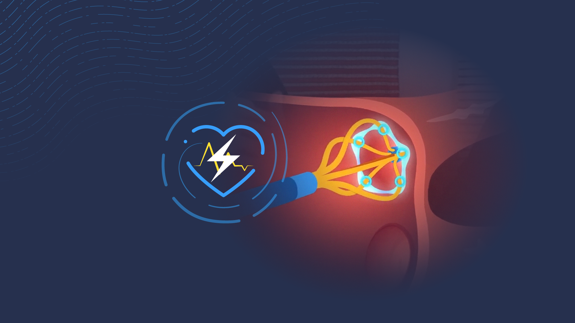 Pulsed Field Ablation (PFA) – hvad er det?