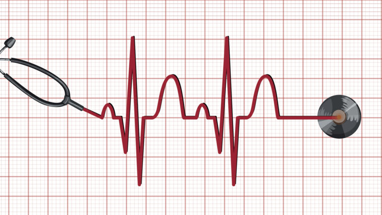 Den normale hjerterytme - Sinusrytme - atrieflimren (hjerteflimmer)