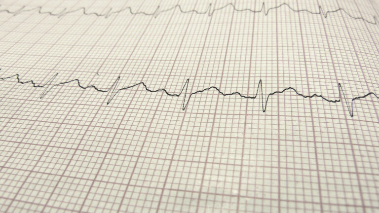 ElektroKardioGram (EKG) - atrieflimren (hjerteflimmer)