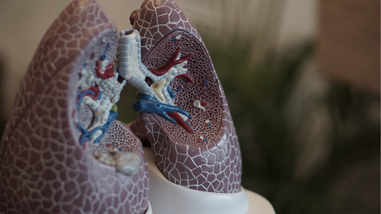 Kronisk obstruktiv lungesygdom - KOL - atrieflimren (hjerteflimmer)