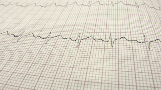 ElektroKardioGram (EKG) - atrieflimren (hjerteflimmer)